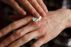 What is Environmental Allergy Skin Testing?