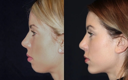 Chin Fillers Treatment in Dubai: What to Expect After Your Procedure