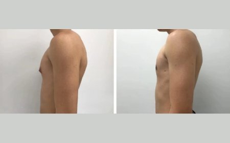 How to Choose the Best Gynecomastia Surgeon for Your Needs in Dubai