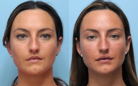 Why Choose the Best Plastic Surgeon in Dubai for Thread Lift Treatments