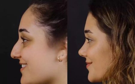 Best Doctors in Dubai for Septoplasty Procedures Using Modern Tech