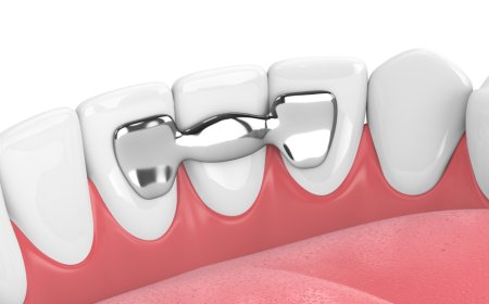 How to Care for Dental Bridges: Maintenance Tips for a Lasting Smile