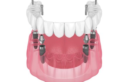 What to Expect from a Full Mouth Reconstruction: Procedures, Process, and Cost Factors