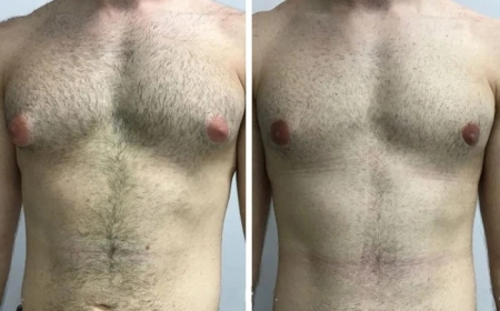 Technology and Equipment Used by the Best Gynecomastia Surgeons in Dubai