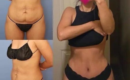 Tummy Tuck in Dubai: The Top Surgeons Who Can Help You Achieve Your Dream Physique