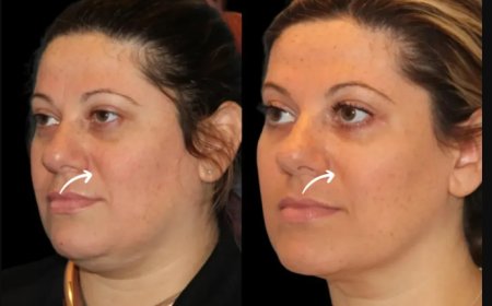 Best Doctors in Dubai on Responsible Sculptra Fillers Use