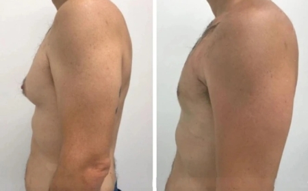 Key Benefits of Treating Gynecomastia in Dubai Early