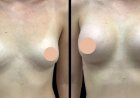 Why the Best Breast Augmentation Surgeon in Dubai Is Key to Achieving Your Desired Results