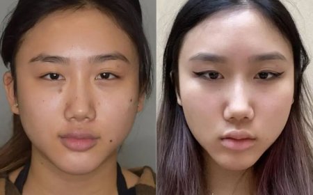 Buccal fat removal Surgery in Dubai and Masculine Facial Contouring