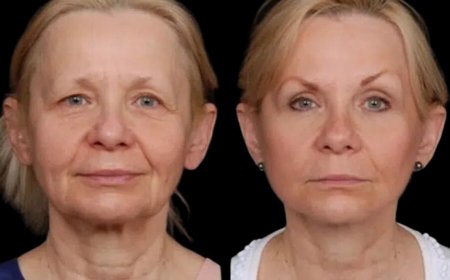 The Best Aesthetic Clinics in Dubai Share Their Under Eye Fillers Techniques