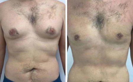 Are Results from Gynecomastia in Dubai Surgery Permanent or temporary?