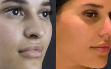 The Best Rhinoplasty Surgeon in Dubai for Teen Rhinoplasty