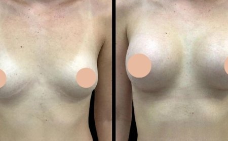 Why the Best Breast Augmentation Surgeon in Dubai Is Key to Achieving Your Desired Results