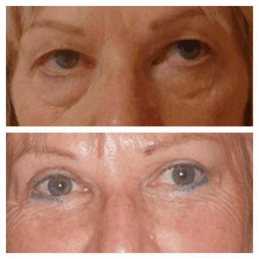 How Much Does Eye Bag Removal Surgery in Dubai Cost?