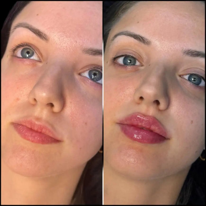 The Science Behind Fillers at the Best Aesthetic Clinics in Dubai